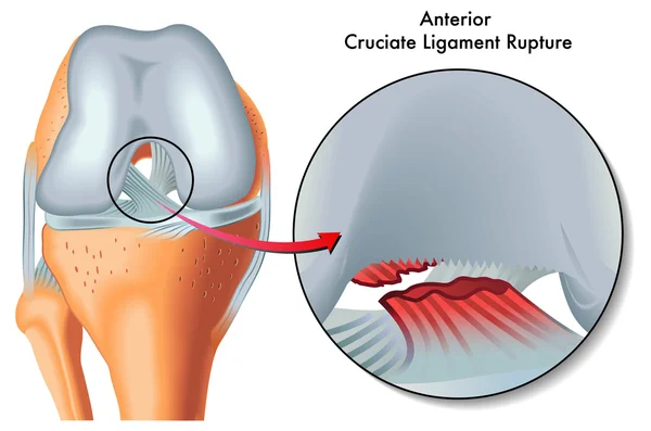 Schéma anatomique du genou montrant la rupture du ligament croisé antérieur
